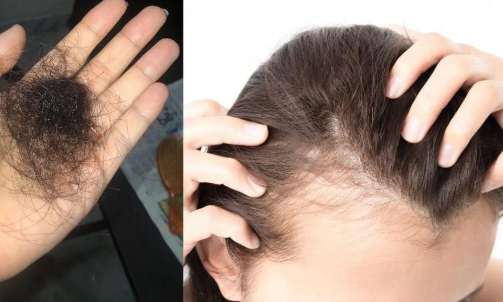 কীভাবে বুঝবেন চুল পড়ছে? প্রতিকার কী?