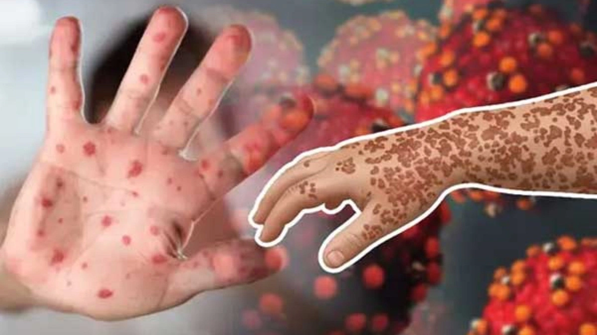 হাম ও উপসর্গে আরও ৫ জনের মৃত্যু