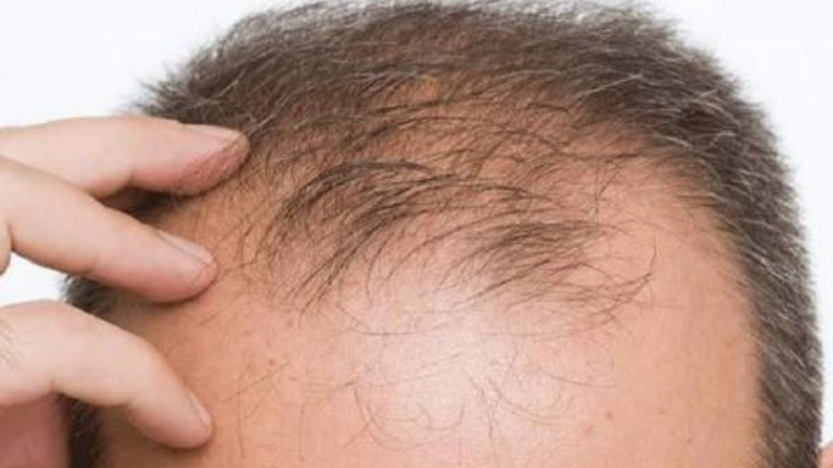 টাক সমস্যার প্রধান কারণ বংশগত