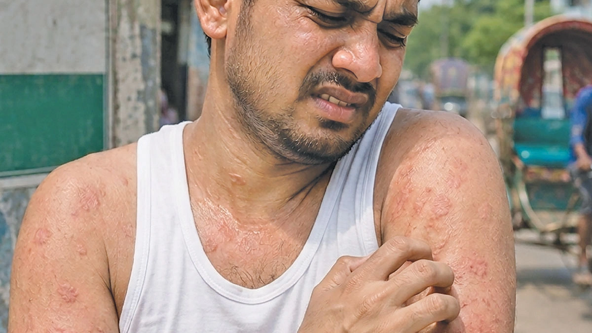 চুলকানি মানেই অ্যালার্জি নয়