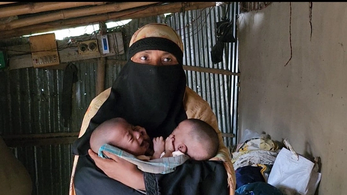 জোড়া লাগা যমজ শিশুর চিকিৎসাধীন অবস্থায় মৃত্যু