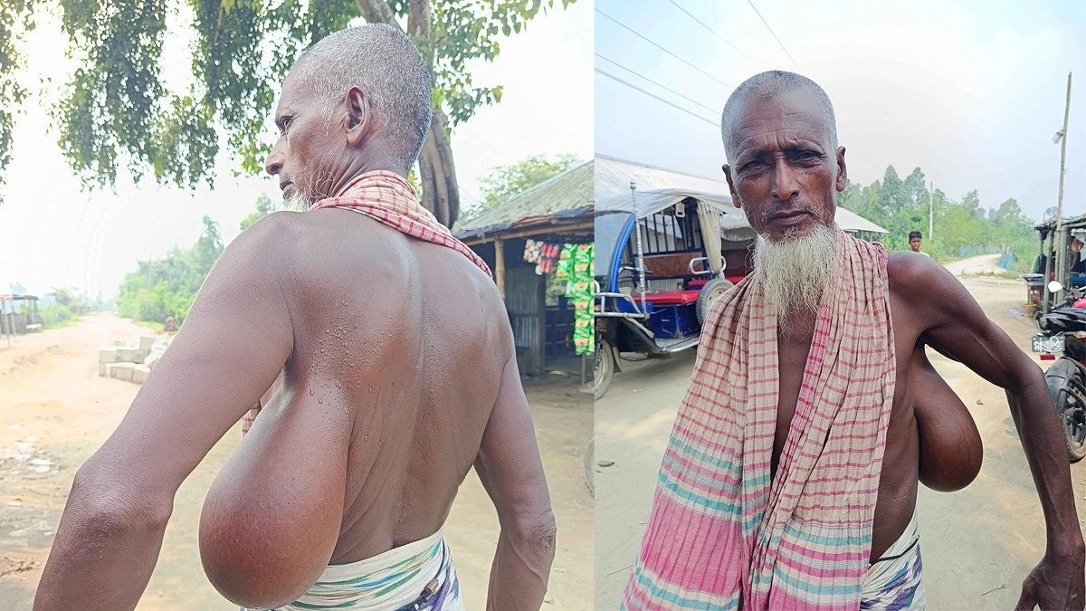 বগলের নিচে ১৫ বছরের টিউমার