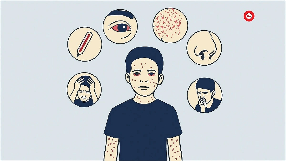 Seven More Deaths from Measles, Suspected Cases