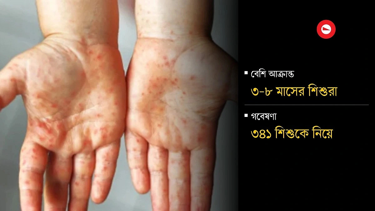 ICDDR,B research: No evidence of genetic changes found in measles virus